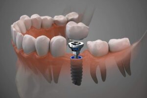 implantes-dentales-que son ventajas botafoch